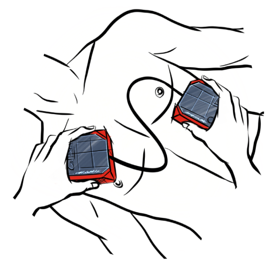 Drawing of the two halves of the defibrillator being attached to a human chest